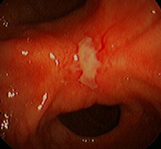 Un ulcère peut être détecté lors d'une gastroscopie.