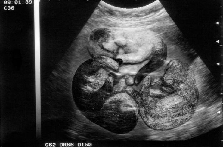 Échographie d'une chienne gestante