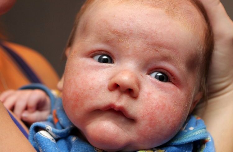 Comment se manifeste l'allergie aux chats chez l'enfant ?