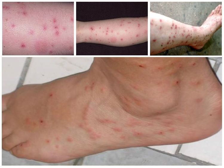 Piqûres de puces sur les jambes humaines