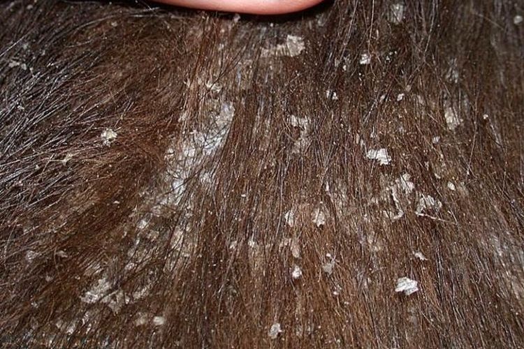 Symptômes de la cheyletiellose