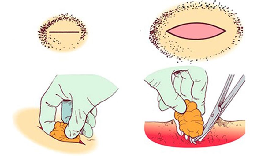 Schéma d'ablation du lipome