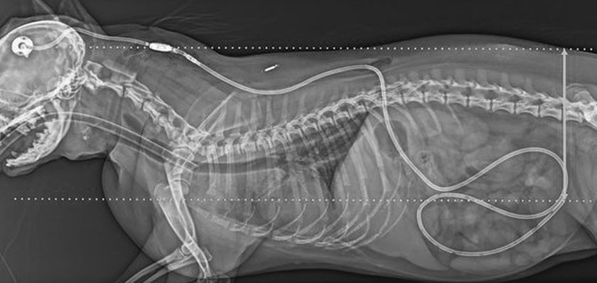 Traitement de l'hydrocéphalie