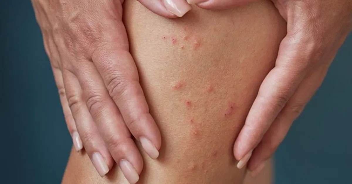 La gale chez l'homme